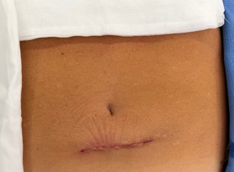Single suprapubic incision after Single Port prostatectomy